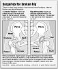 Manual Pull Cable/Wire to open trunk, 123-hip-fracture-repair-3-2-.jpg