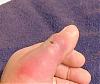 Brown Recluse Spider Bite-recluse2.jpg