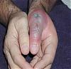 Brown Recluse Spider Bite-recluse3.jpg